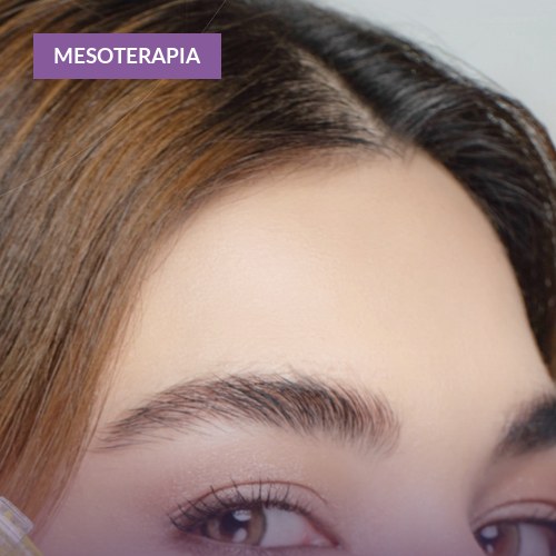 Qué es la mesoterapia facial